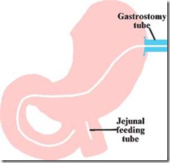 gj-tube